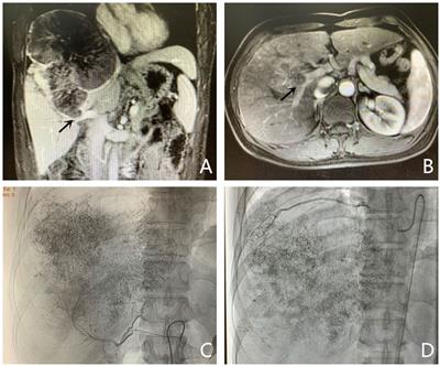 Conversion Therapy of Large Unresectable Hepatocellular Carcinoma With Ipsilateral Portal Vein Tumor Thrombus Using Portal Vein Embolization Plus Transcatheter Arterial Chemoembolization